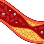 snel cholesterol verlagen