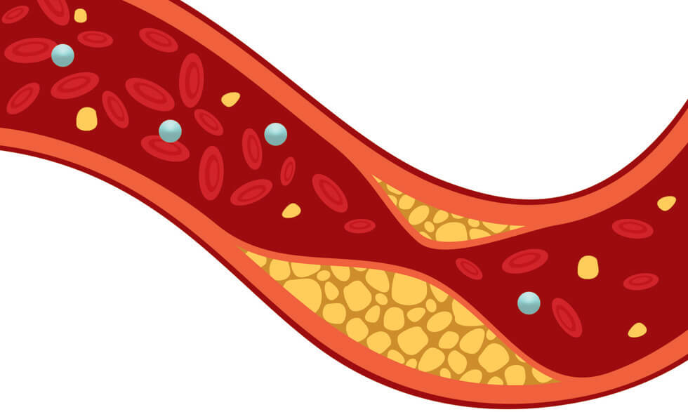 snel cholesterol verlagen