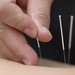 afvallen met acupunctuur