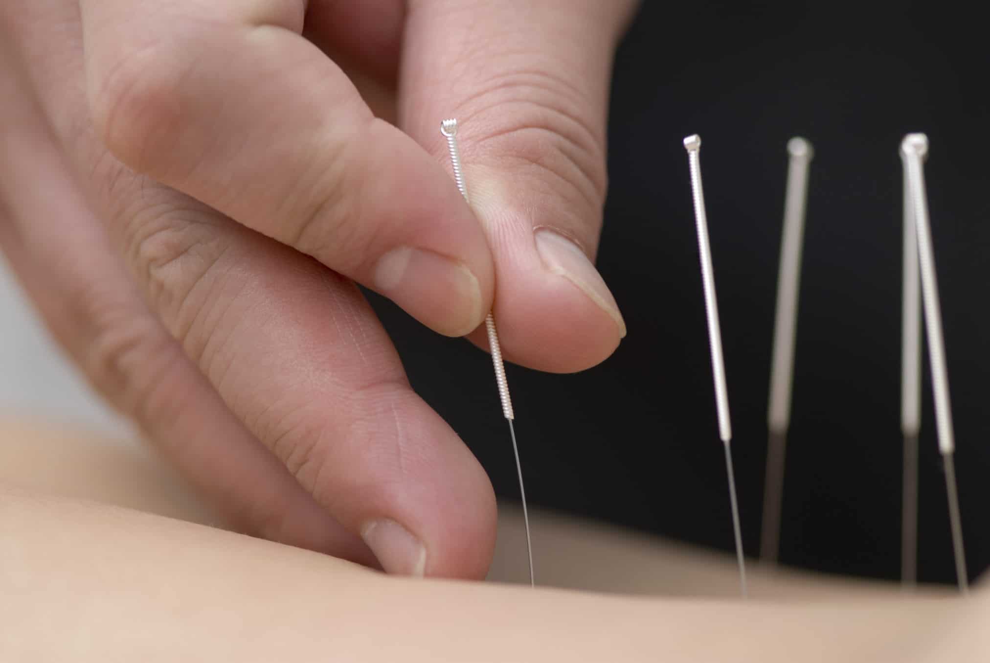 afvallen met acupunctuur